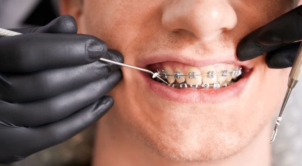 orthodontist-placing-rubber-bands-on-male-patient-2022-05-30-22-51-34-utc orthodontist-placing-rubber-bands-on-male-patient-2022-05-30-22-51-34-utc